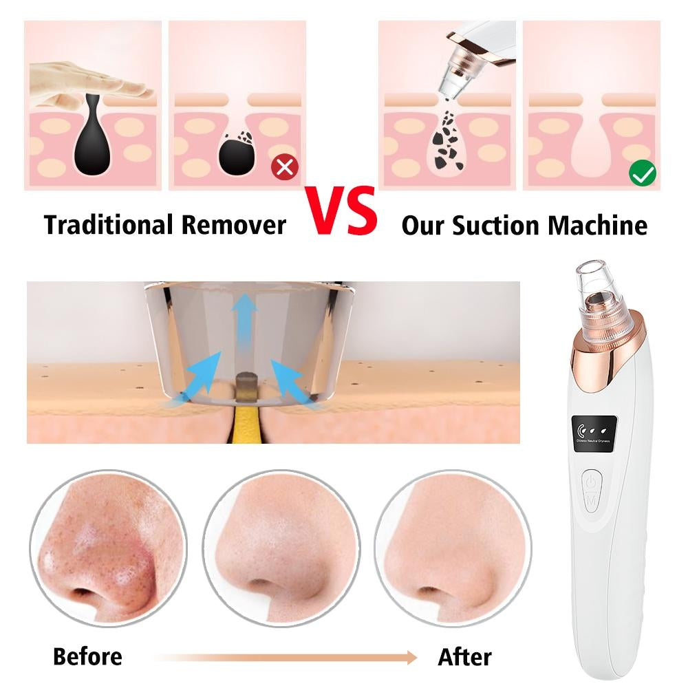 5in1 Rechargeable Blackhead Remover and Vacuum Suction Acne Pore Cleaner